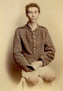 Double amputee, American Civil War (1860s) (Source: Collectors Weekly)