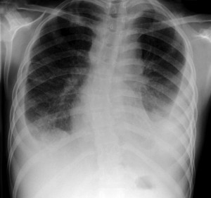 Pulmonary tuberculosis in a child (source: radiopaedia.org)